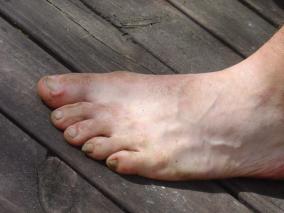 Rotten Foot
